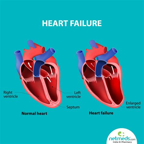 what causes left ventricular dysfunction.